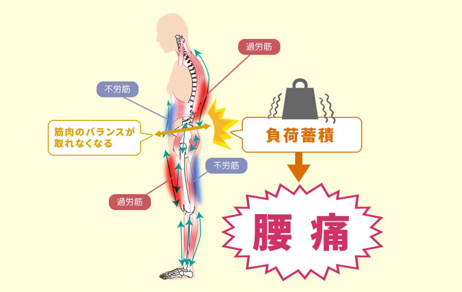 腰痛発生の例
